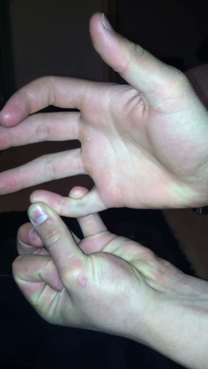 Breaking my finger
