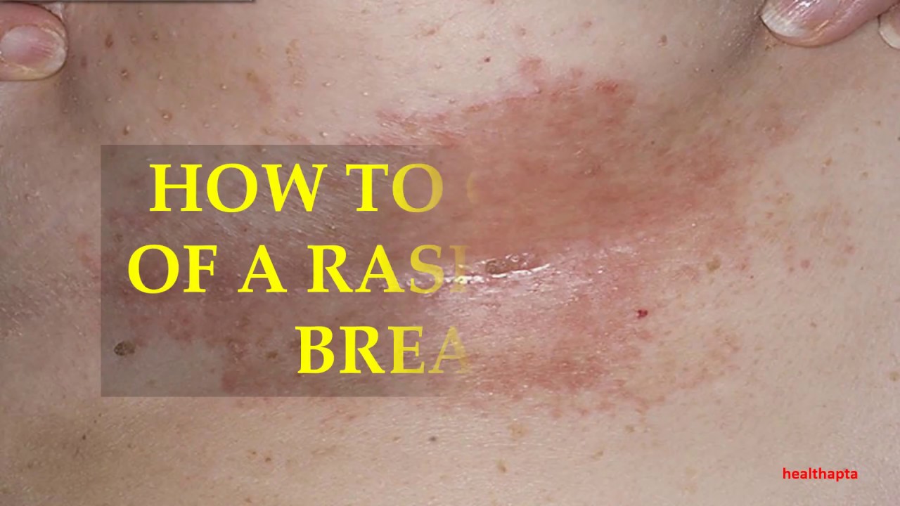 HOW TO GET RID OF A RASH UNDER BREASTS 