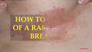 LadyCareHealth on X: 5 Remedies That Can Help You Get Rid Of Rashes Under  Your Breasts  #rashes #underbreast   / X