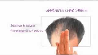 implant capillaire nice tarif implant capillaire nice tarif