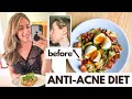 Anti-Acne Diet: What I Eat in a Day for Hormonal Acne