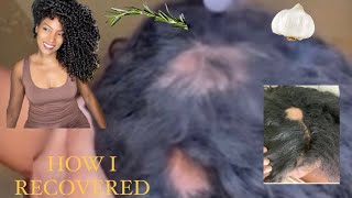 My Alopecia Journey | Why I’ve Been Gone