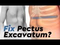 Pectus Excavatum and the Nuss Procedure