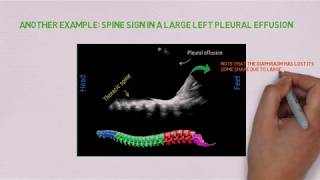 Pleural effusion on ultrasound: the spine sign