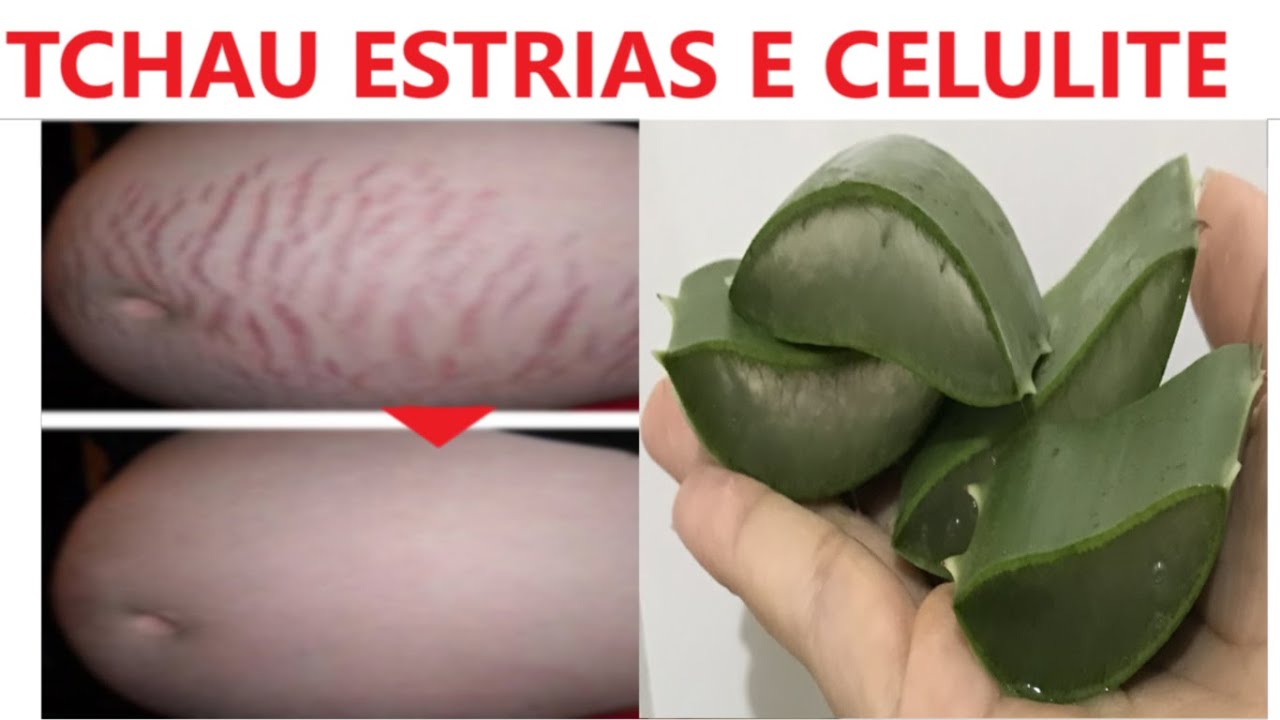 Babosa Nas Estrias Antes E Depois - RETOEDU