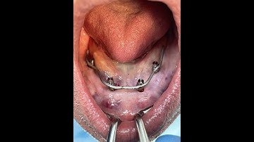 STEP BY STEP INTRAORAL WELDING CONOMETRIC CONNECTION IMMEDIATE LOADING HD 720p