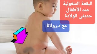 البقعة المنغولية عند الأطفال حديثي الولادة