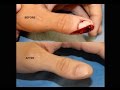 Amazing Thumb Tip Regeneration! IV3000 Wound Dressing for Thumb / Finger Trauma