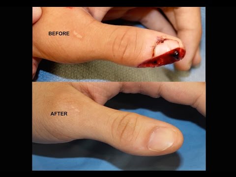 Amazing Thumb Tip Regeneration! IV3000 Wound Dressing for Thumb / Finger Trauma