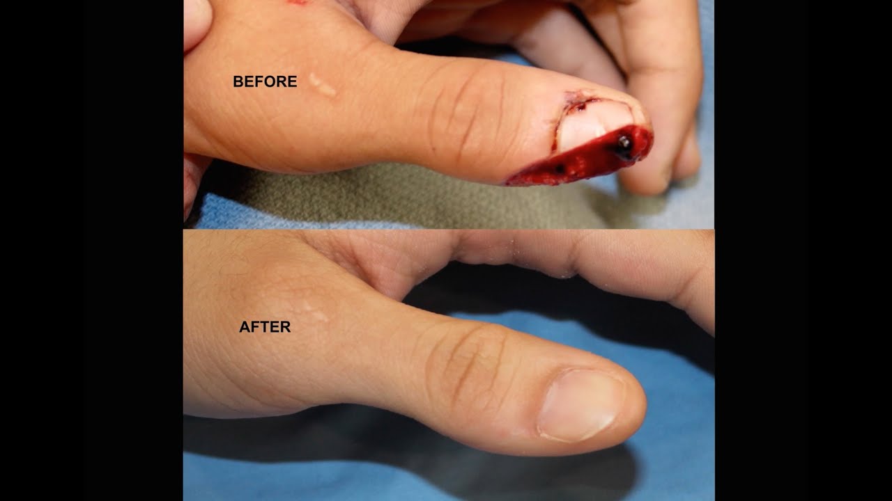 Cut-off finger: First aid, treatment, and recovery