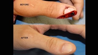 Amazing Thumb Tip Regeneration! IV3000 Wound Dressing for Thumb / Finger Trauma screenshot 5