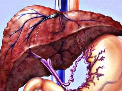 Portal Hypertension and complications of liver cirrhosis