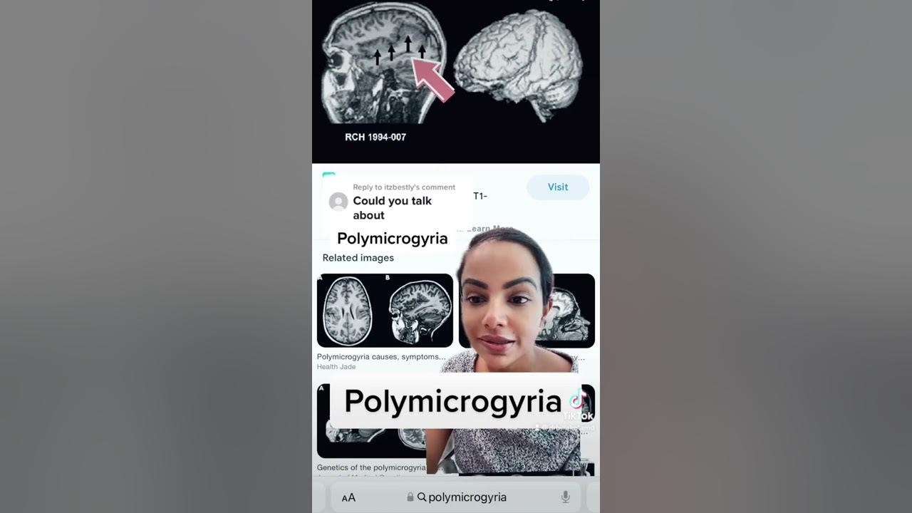 Living With Polymicrogyria What To Expect As Your Child Grows - 3i65ctb