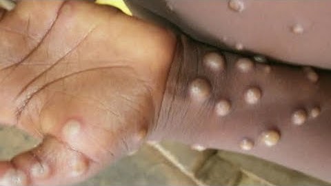 Health experts address top questions about monkeypox