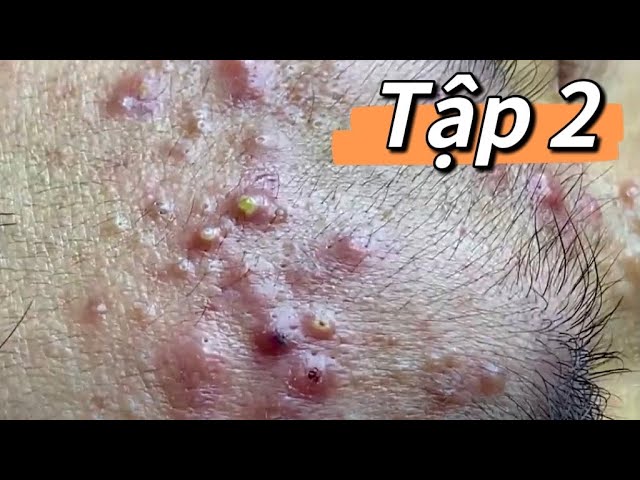 (Tập 2) Cùng xem lấy nhân mụn cho nam sinh lớp 12 cùng Huyền nhé #mun #acne