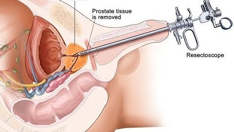 TURP explained and animation