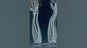 Both forearms both bone fractures managed by conservative method