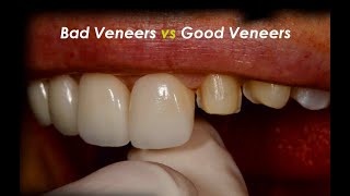 Bad Veneer vs Good Veneer