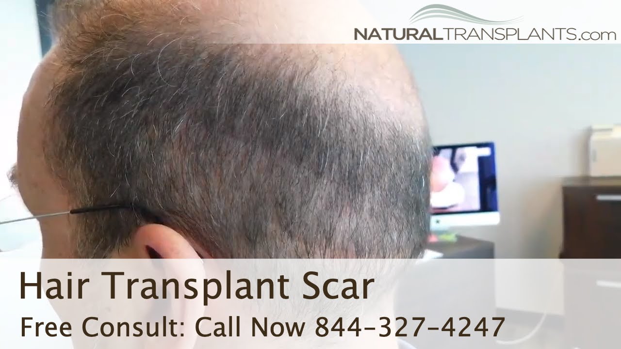 fue hair transplant month by month Hair Transplant Scar - Natural Transplants vs Other Clinic Hair Transplant Scar