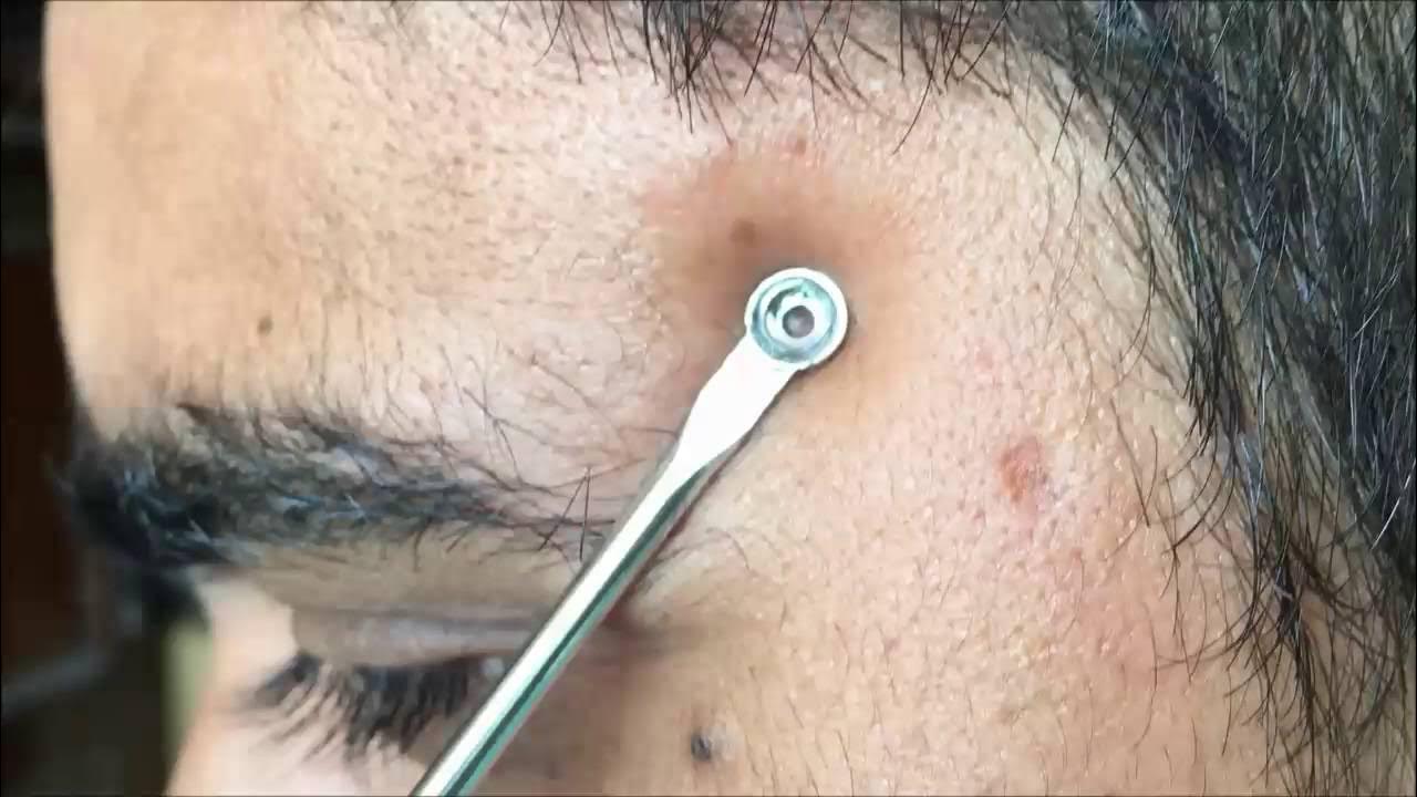 Extracting Blackhead near eye YouTube