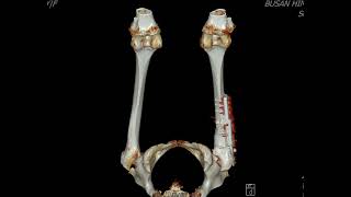 Subcapital femur neck fracture