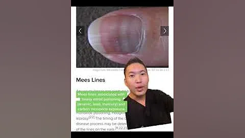 #shorts How your nails reflect your health Part 3