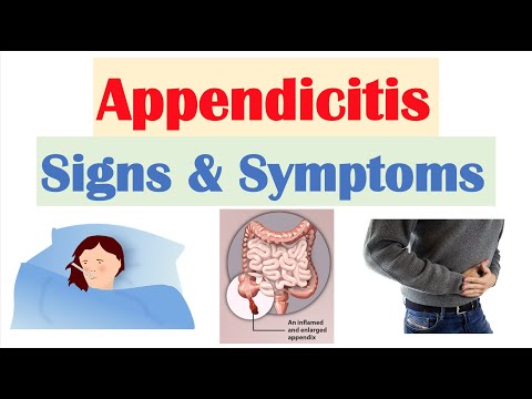 Video: Appendicitis - Signs And Symptoms Of Acute And Chronic Appendicitis. Where Is Appendicitis Located?