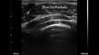 Supinator Radial Tunnel Deep Branch Of Radial N