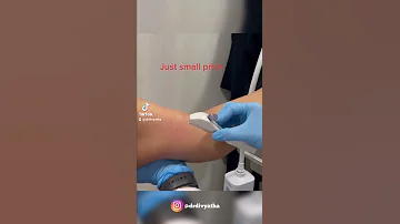 Implanon Placement شريحة منع الحمل 