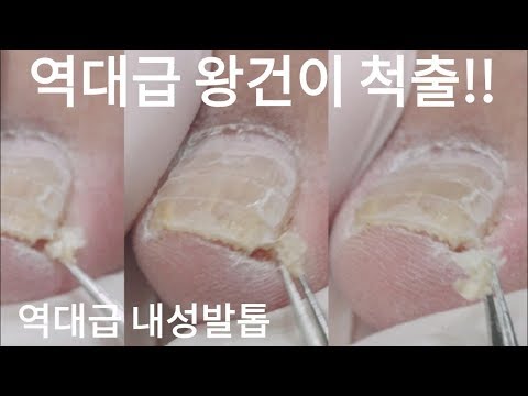 [시원함주의!!]😱역대급 내성 발톱!!😨왕건이 제거할 때 고객님 환호하심!!끝까지보세요👍왕건이 대환장파티!!(ingrown toenail / toenails with fungus)