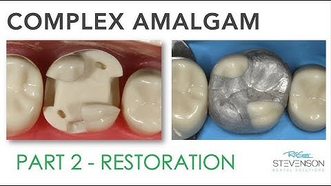 Complex Amalgam Restoration | Part 2