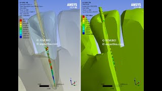 Famous Endodontics or root canal treatment on an incisor with pulp removal - ANSYS WB Explicit Dynamics Wealth