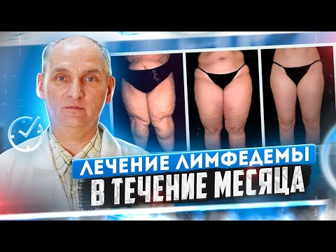 Бейне: Лимфедеманы емдеудің 4 қарапайым әдісі