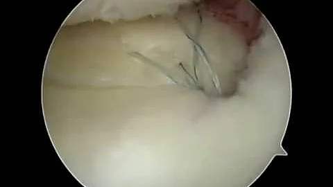 Root Repair Techniques by Dr  Justin Saliman featuring the Ceterix NovoStitch Plus