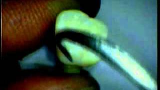 Identification of Teeth (Deciduous molars) part 5 of 6.m4v