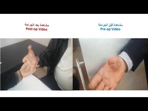 تصنيع إبهام اليد باستخدام إصبع القدم       