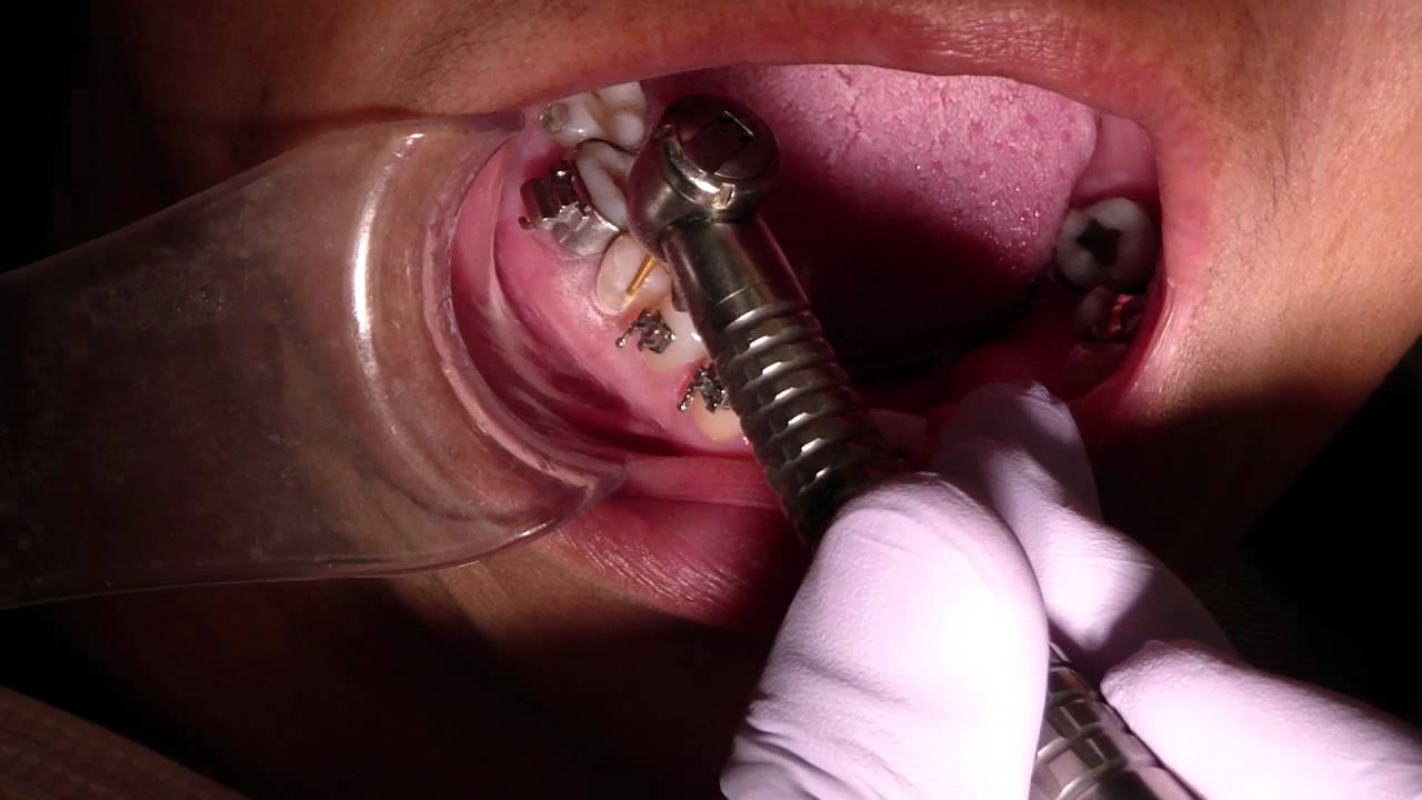 The Trick To Removing Composite From Enamel