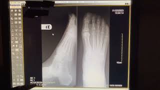 Anatomical Structure of a Foot on XRAY