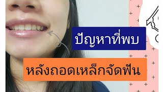 ปัญหาหลังถอดเหล็กจัดฟัน | โบว์เอง