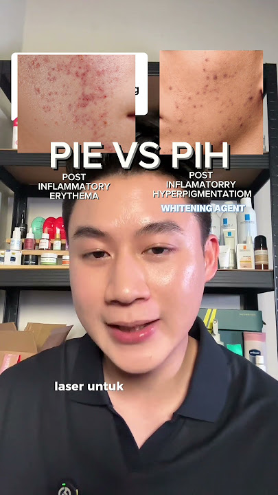 Bekas jerawat PIE dan PIH mana yang lebih susah dihilangin? #acne #jerawat #bekasjerawat