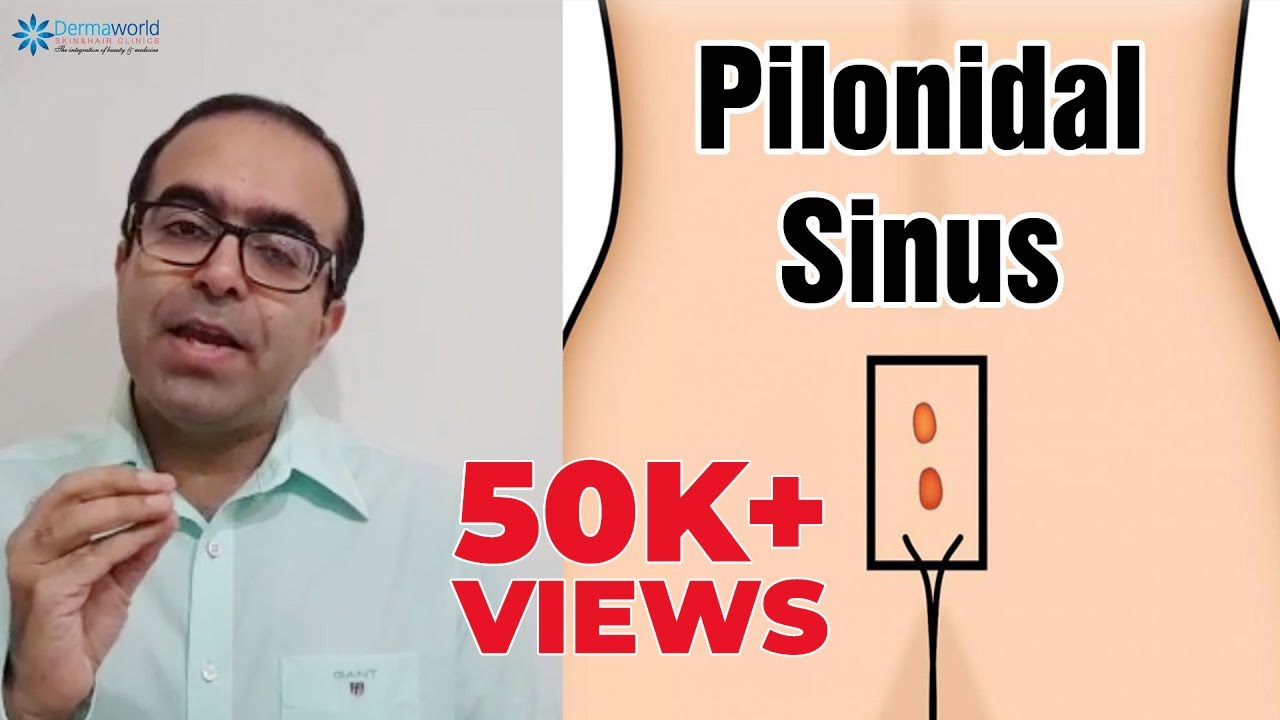 Living With Pilonidal Sinus- Things To Take Care Of - Pristyn Care