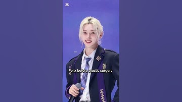 Felix before plastic surgery vs after plastic surgery #straykids #felix #leefelix #thunderous
