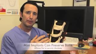 Dental Implants: How Mini Implants can help Bone Loss and gum disease
