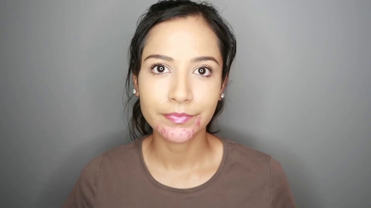 How To Cover Cystic Acne With Makeup
