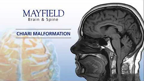 Mayfield Minute: Chiari Malformation