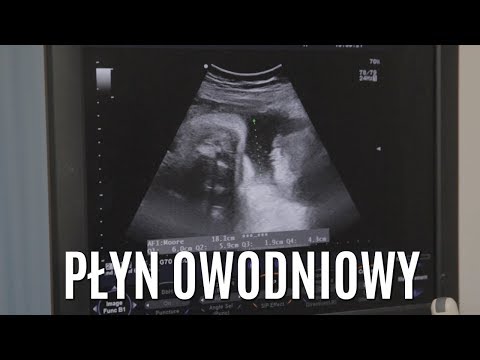 Wideo: Za Dużo Płynu Owodniowego: Czy Powinienem Obawiać Się Wielowodzie?