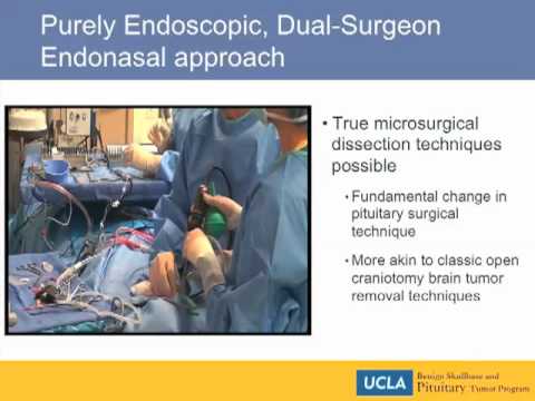 Endoscopic Pituitary Surgery | UCLA Pituitary Tumor Program