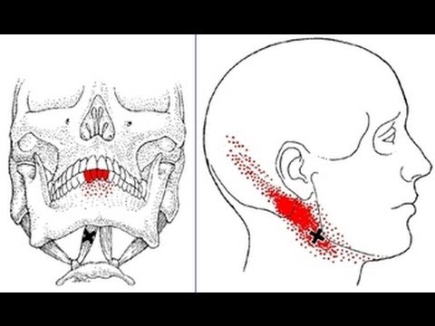 Jaw, Neck, Head, and Teeth Pain from Digastric Muscle ... under chin diagram 