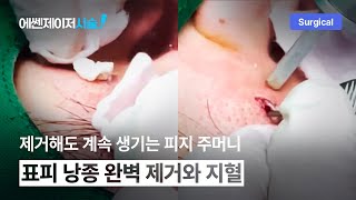 제거해도 계속 생기는 피지 주머니, 표피 낭종 완벽 제거와 지혈 l #co2레이저 #표피낭종