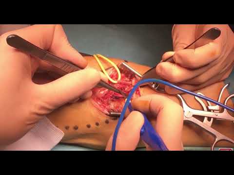 Video: Fistula Arteriovenous - Gejala, Rawatan, Bentuk, Peringkat, Diagnosis